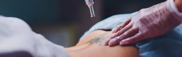 Technique used for Tattoo Removal