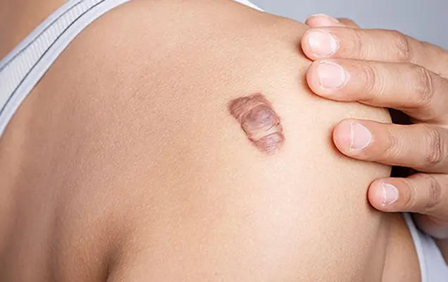 Technique Used for Keloid Treatment