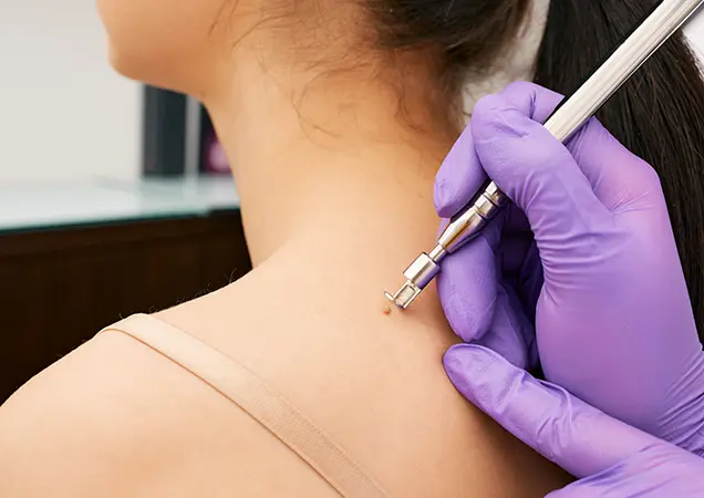 Best Mole Treatment Doctor Bhubaneswar