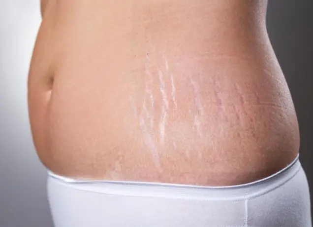 Stretch Marks Removal in Bhubaneswar