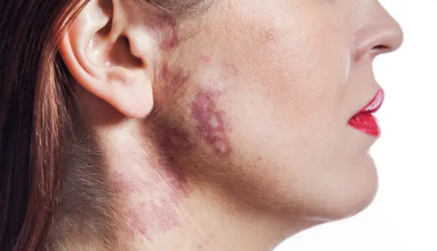 Birthmarks removal treatment in bhubaneswar