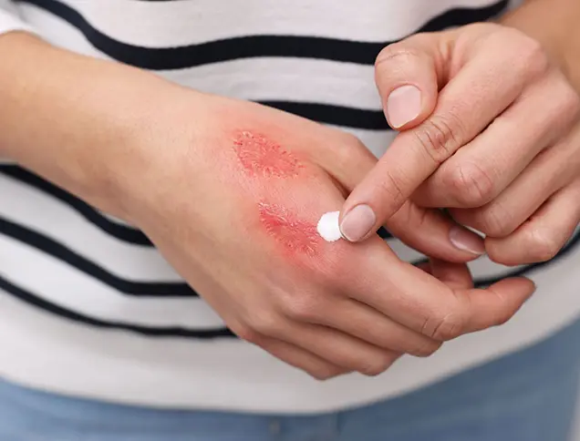 burn scar removal treatment bhubaneswar