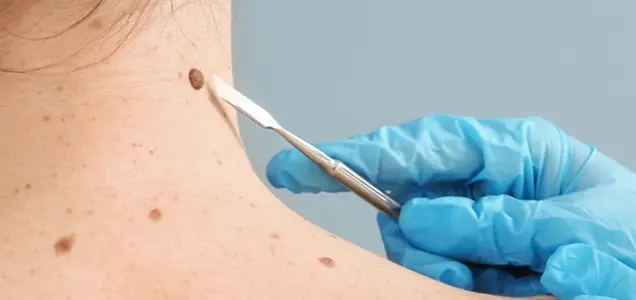 Skin Tag Treatment in Bhubaneswar