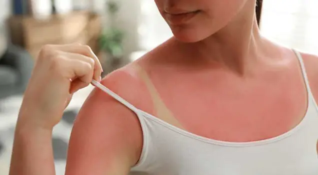 Technique Used for Sun Tan Removal