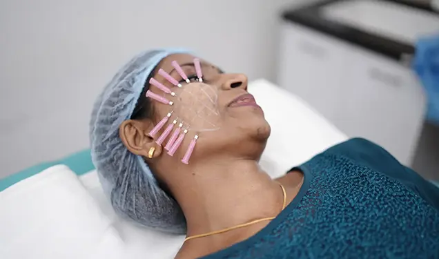 Carbon Peel for Rosacea Treatment