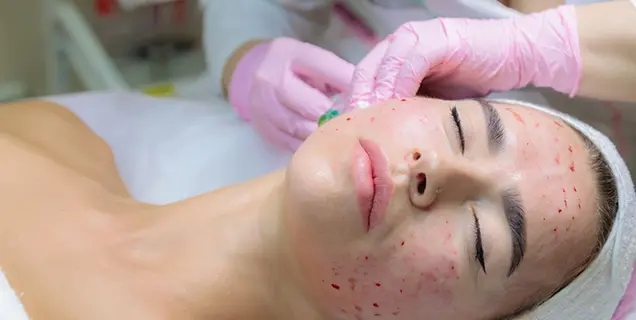 Process Of Vampire Facial Treatment