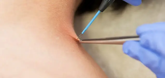 Wart Removal Treatment in Bhubaneswar